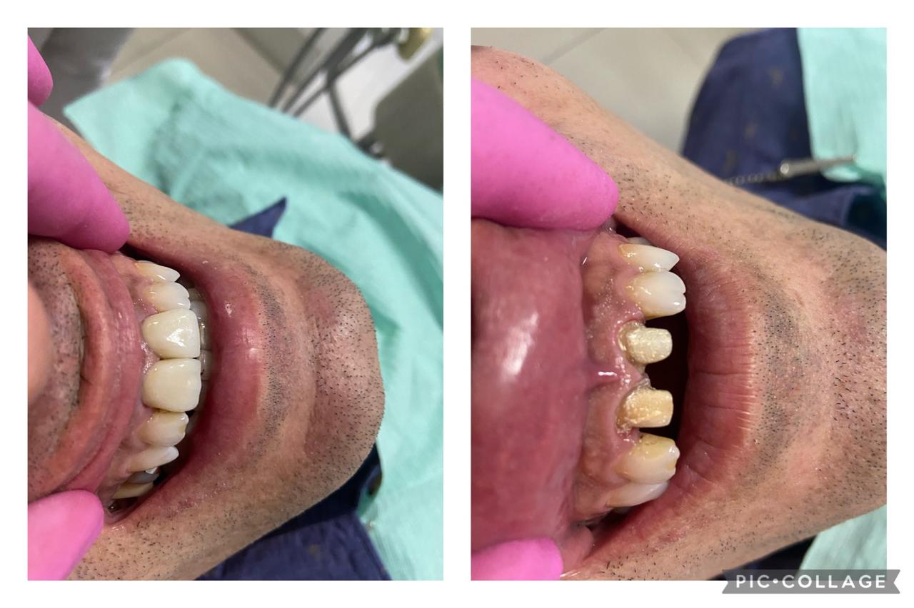 Resultado antes e depois